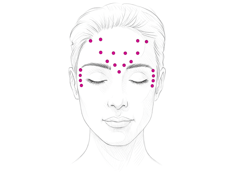 Injektionsschema Faltenbehandlung Botulinumtoxin Behandlung
