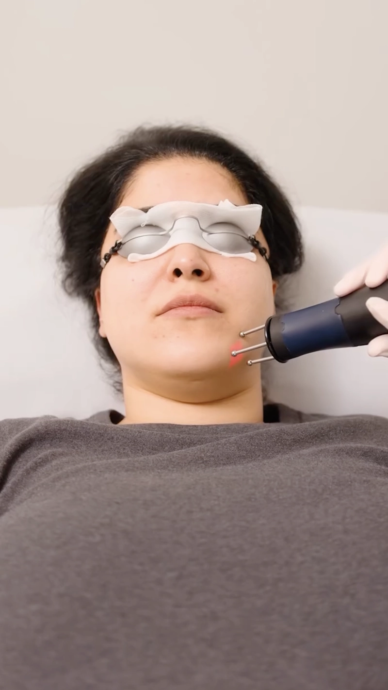 Vorschaubild: Ein sanftes Laser-Peeling kann helfen, dein Hautbild sichtbar zu verbessern.