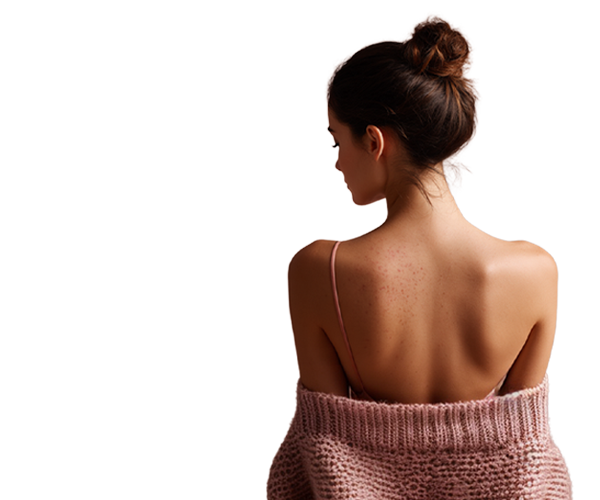 Narben Akne Behandlung In Basel